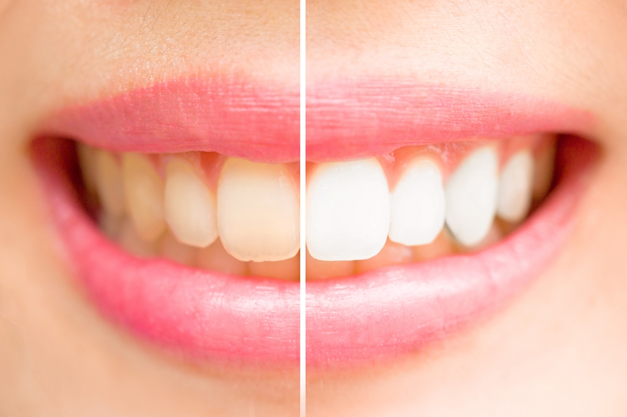 Jak przebiega wybielanie zębów metodą nakładkową?